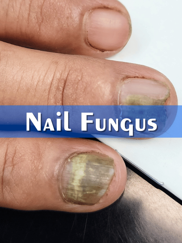 Nail Fungus